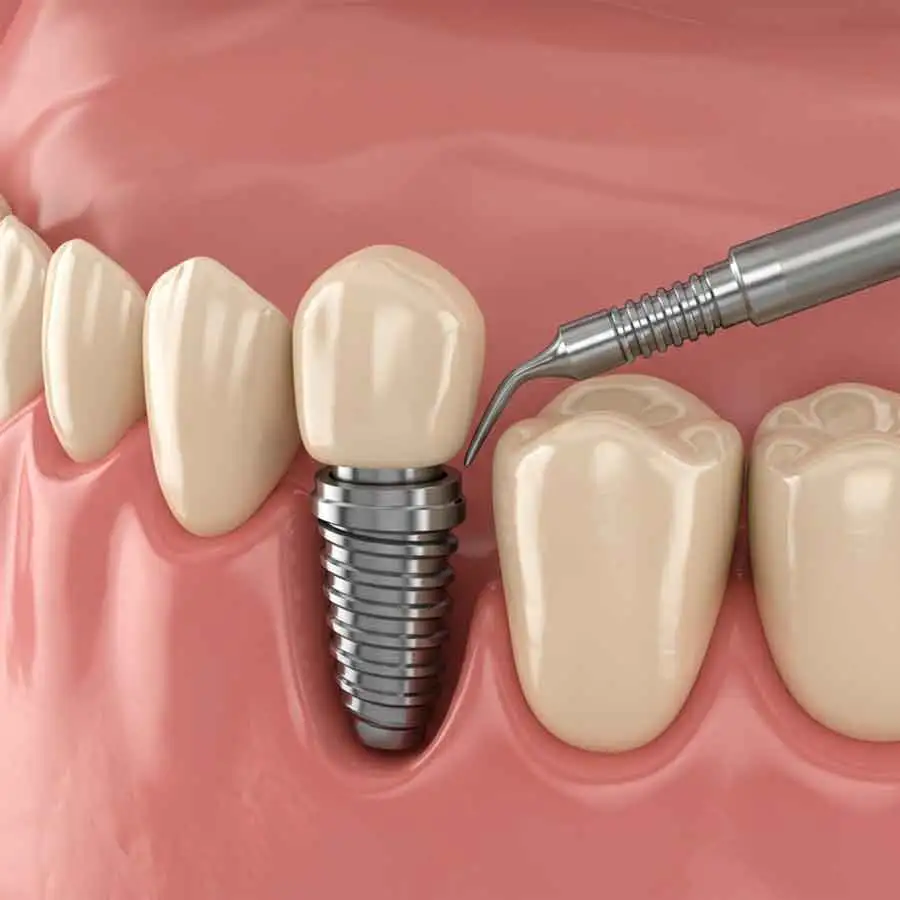 impianti Dentali Como